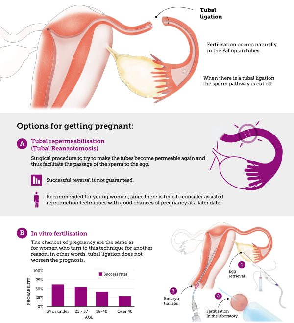 Can I Get Pregnant after Tubal Ligation? | Eugin IVF Clinic